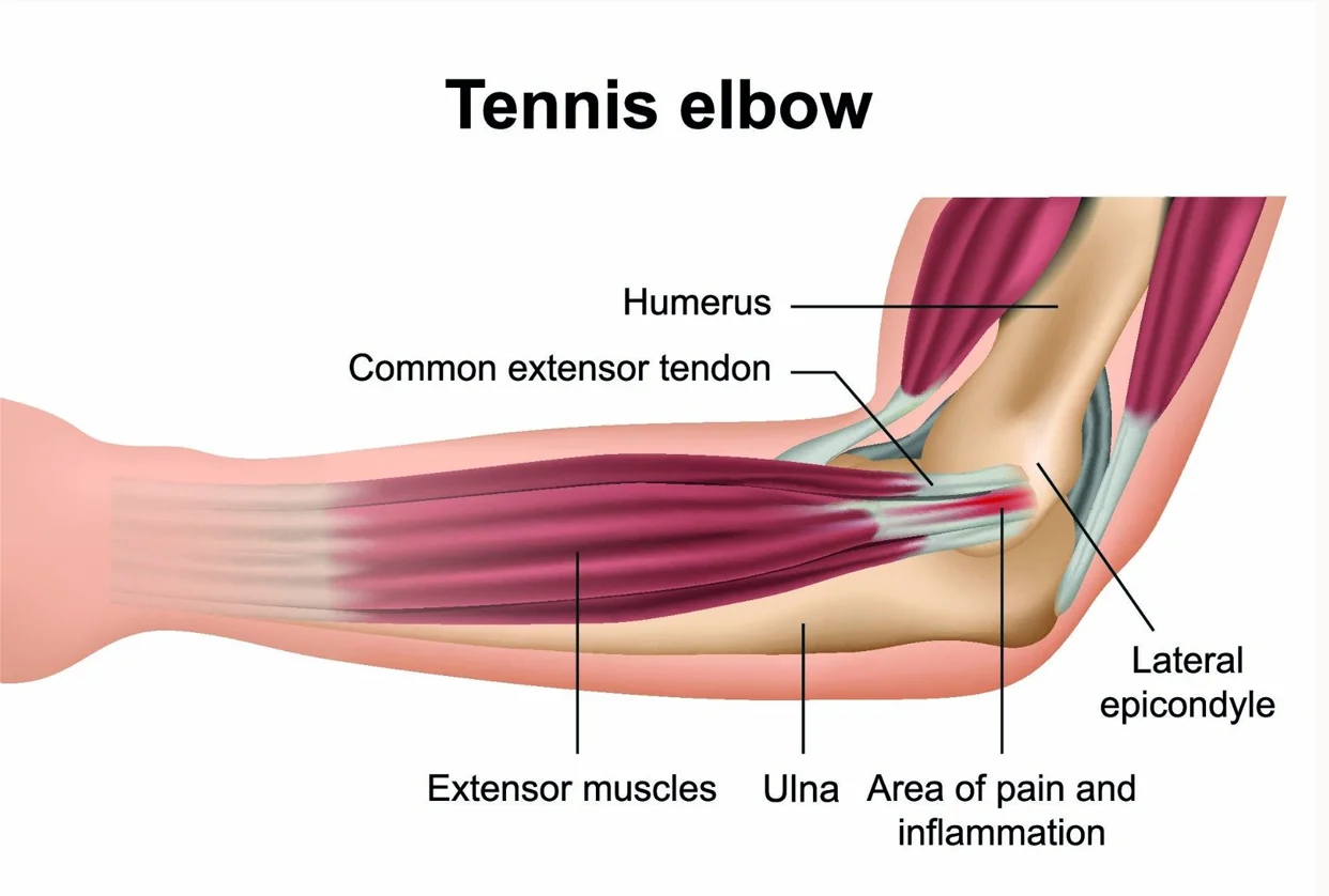 Tennis Elbow